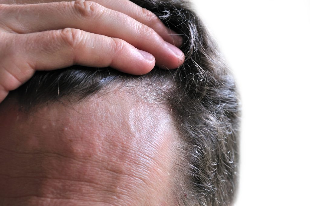 Male hair with dandruff when looking for Male Hair Care Barber Frankfort.